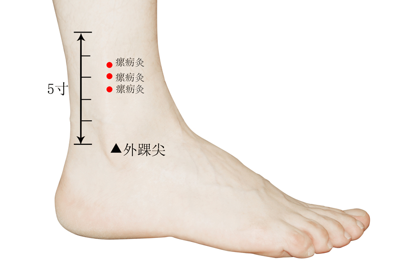 瘰疬灸